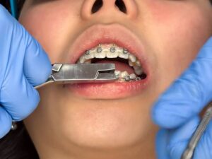How Often Should You Visit the Orthodontist During Treatment?